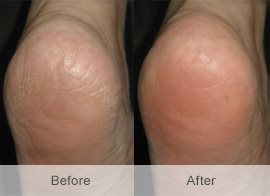 Hansaplast FOOT EXPERT Κρέμα ανάπλασης ποδιών, για ξηρό δέρμα με 10% URIA,100 ml + ΔΩΡΟ Αποσμητικό Spray Ποδιών -2